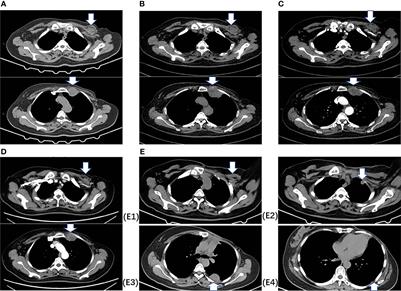 Case Report: An Internal Mammary Rhabdomyosarcoma After Mastectomy and Systemic and Radiation Therapy in a Patient With Breast Cancer